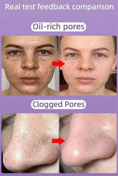 Salicylic Acid Pore-Refining Cream – Blackhead &amp; Large Pore Treatment