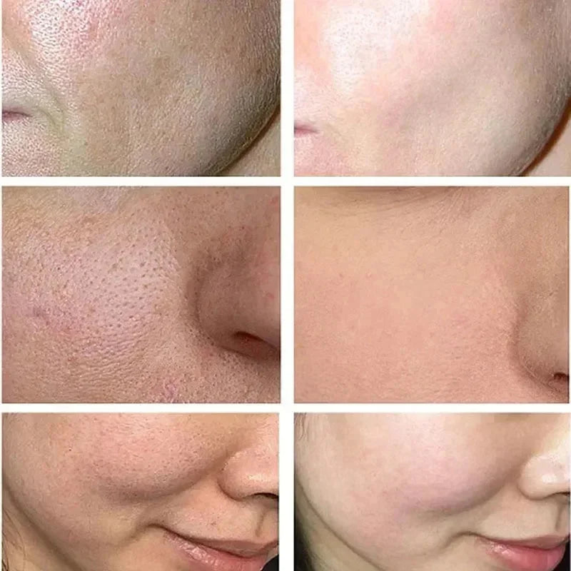Salicylic Acid Pore-Refining Cream – Blackhead &amp; Large Pore Treatment