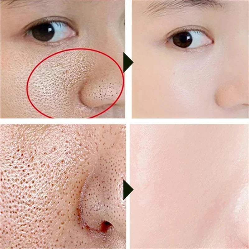 Salicylic Acid Pore-Refining Cream – Blackhead &amp; Large Pore Treatment