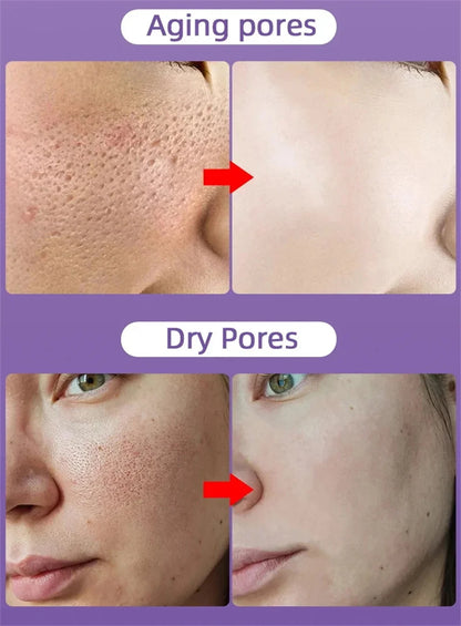 Salicylic Acid Pore-Refining Cream – Blackhead &amp; Large Pore Treatment