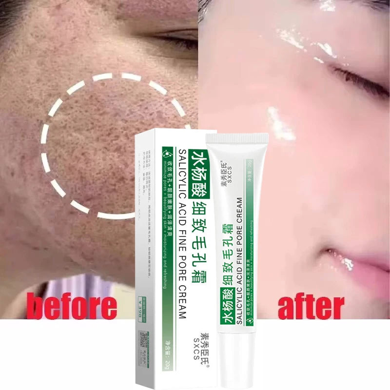 Salicylic Acid Pore-Refining Cream – Blackhead &amp; Large Pore Treatment
