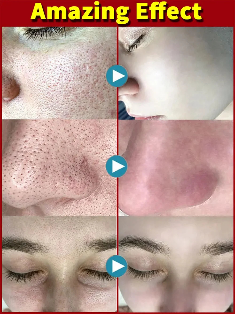 Salicylic Acid Pore-Refining Cream – Blackhead &amp; Large Pore Treatment