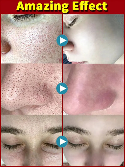 Salicylic Acid Pore-Refining Cream – Blackhead &amp; Large Pore Treatment