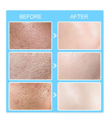 Salicylic Acid Pore-Refining Cream – Blackhead &amp; Large Pore Treatment